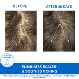 DS Hair Kerato-Reducing Treatment Shampoo - Severe Dandruff & Scaly Conditions