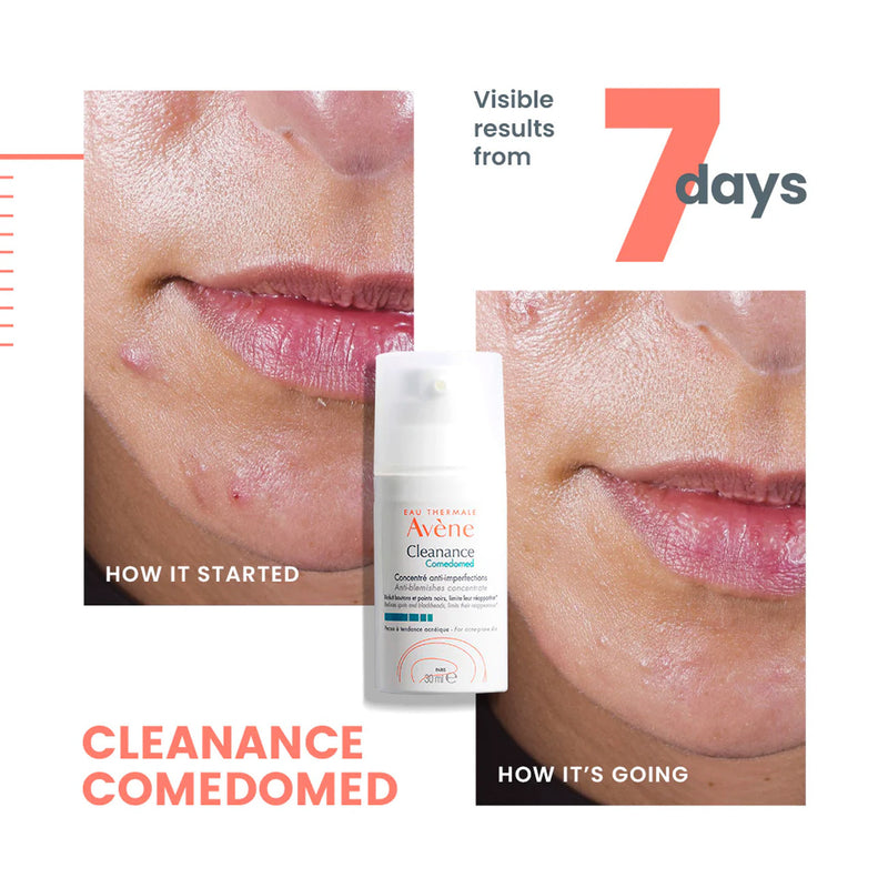 Cleanance Comedomed Anti-Blemishes Concentrate - Acne-Prone Skin