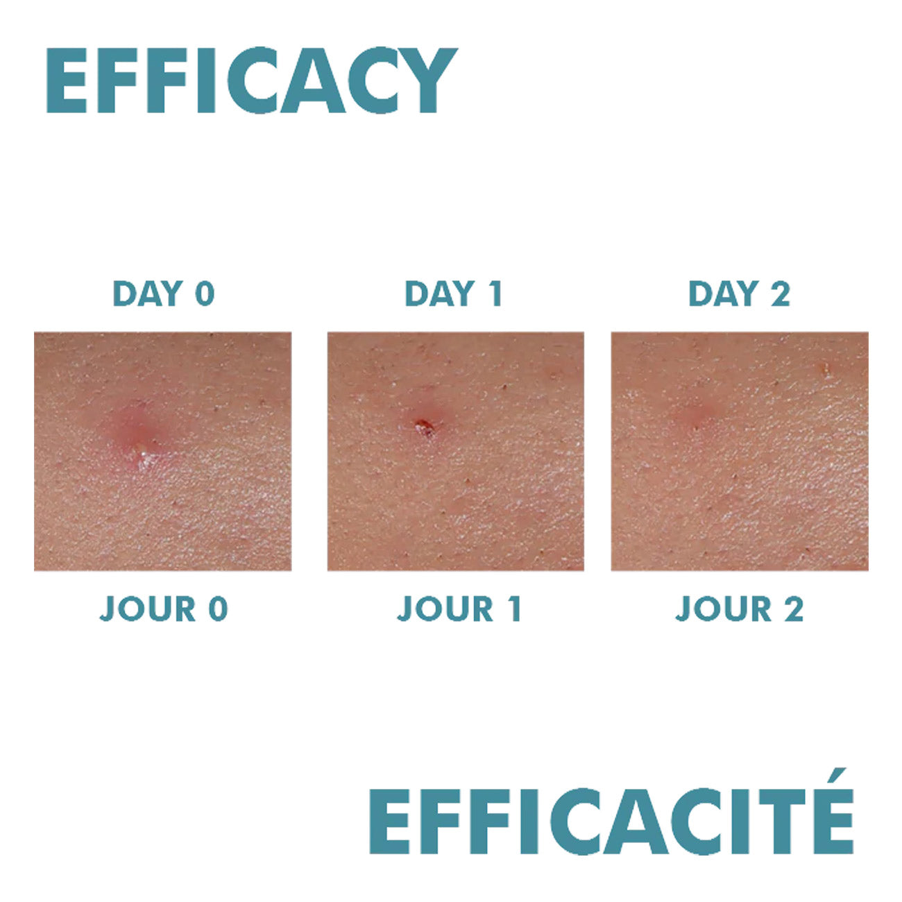 Cleanance Comedomed Peeling Intensive Spot Breakout Cream