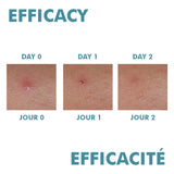 Cleanance Comedomed Peeling Intensive Spot Breakout Cream