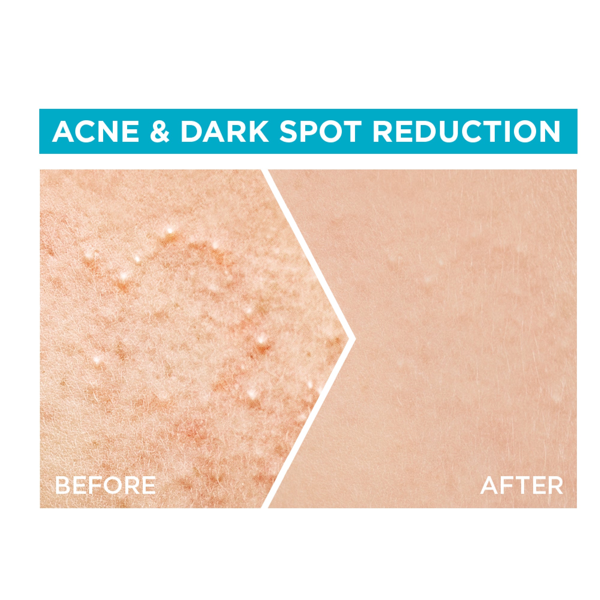 Garnier Fast Clear 4% Salicylic Acid, Vitamin C, Niacinamide, AHA - Anti-Acne Treatment Booster Serum