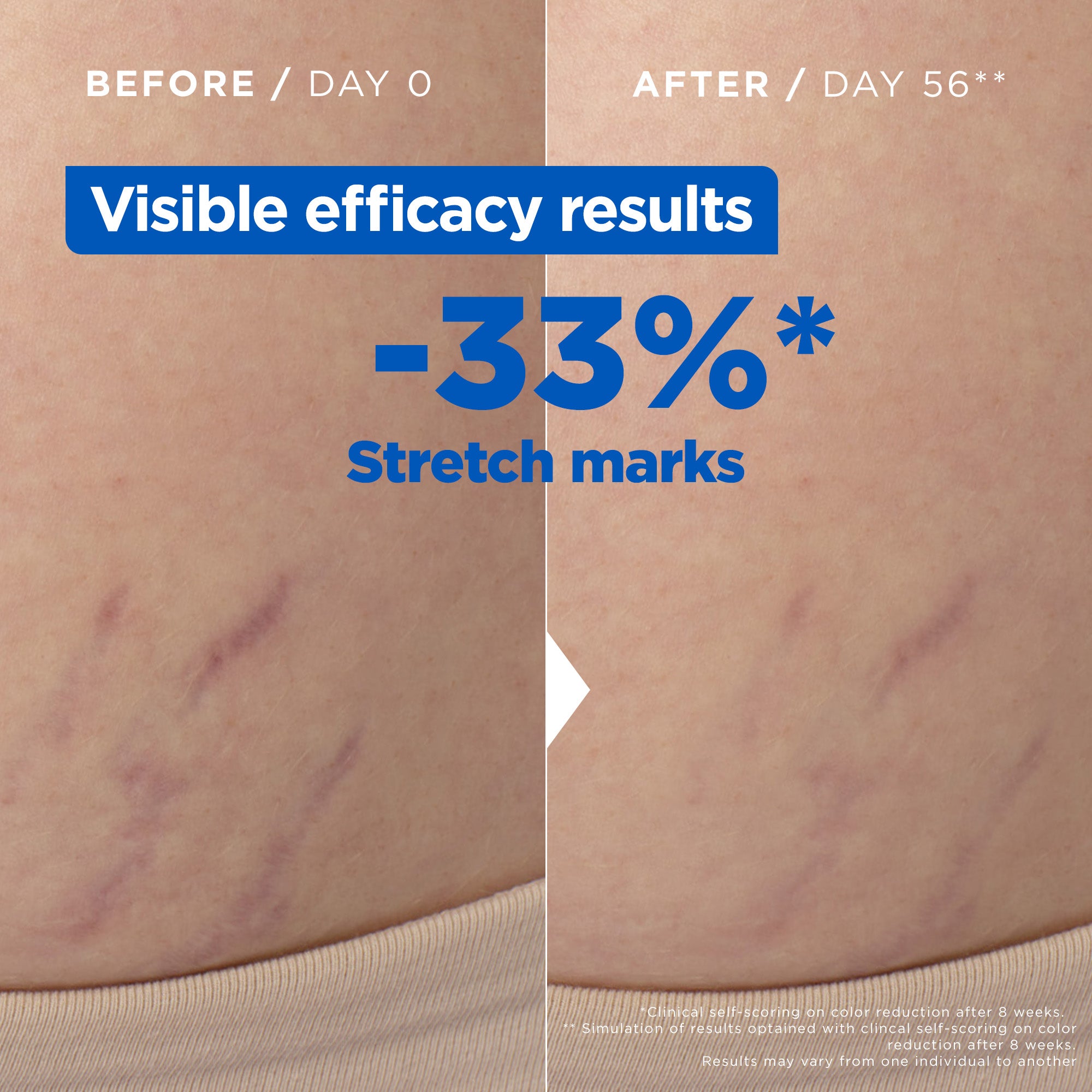 Mixa Anti Stretch Mark Oil - For Skin with Stretch Marks - With Omega 6 & 9