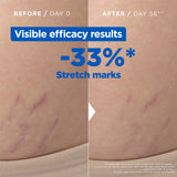 Mixa Anti Stretch Mark Oil - For Skin with Stretch Marks - With Omega 6 & 9