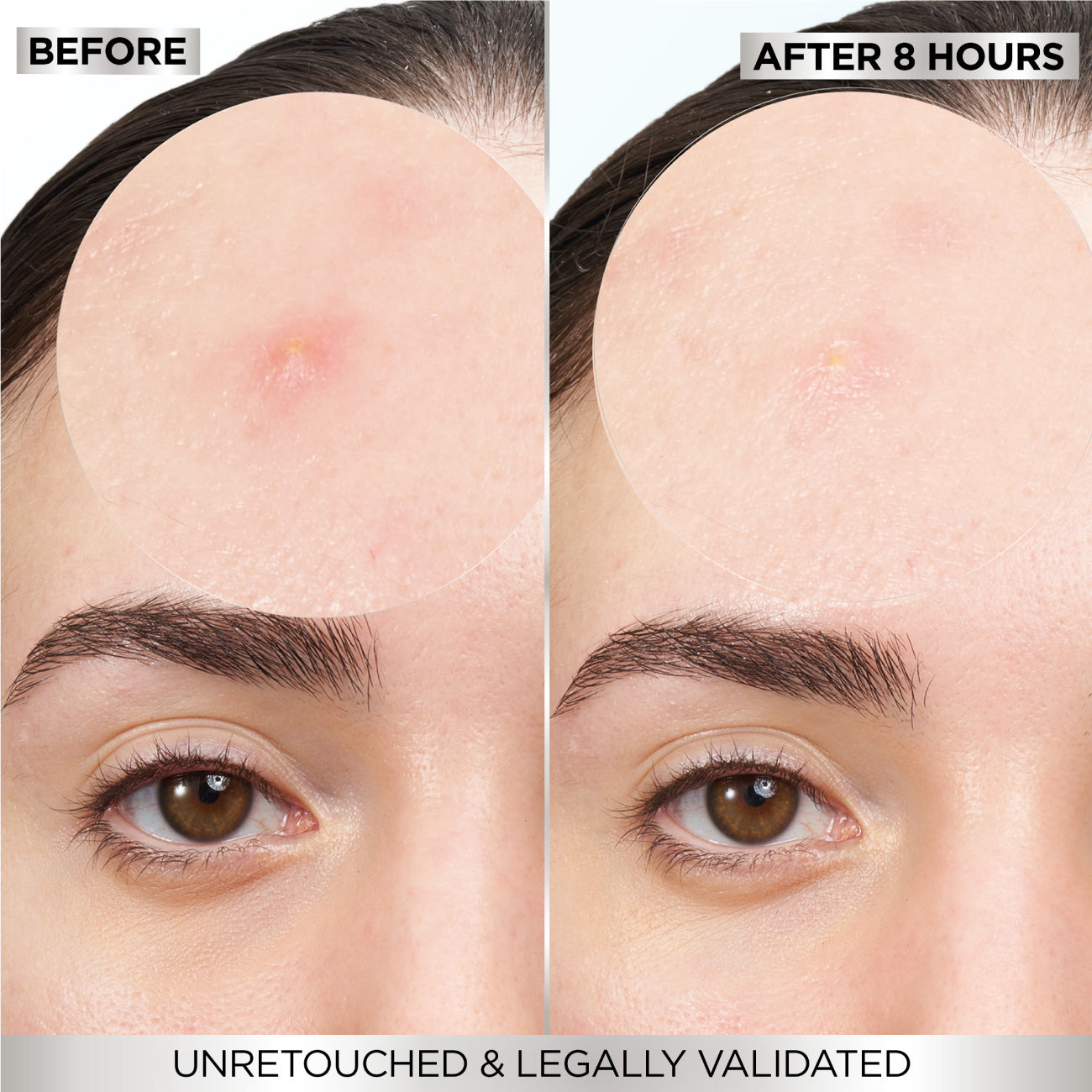 Skin Active  Fast Clear Invisible Pimple Patch 8 Hours Hydrocolloid