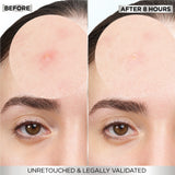 Skin Active  Fast Clear Invisible Pimple Patch 8 Hours Hydrocolloid