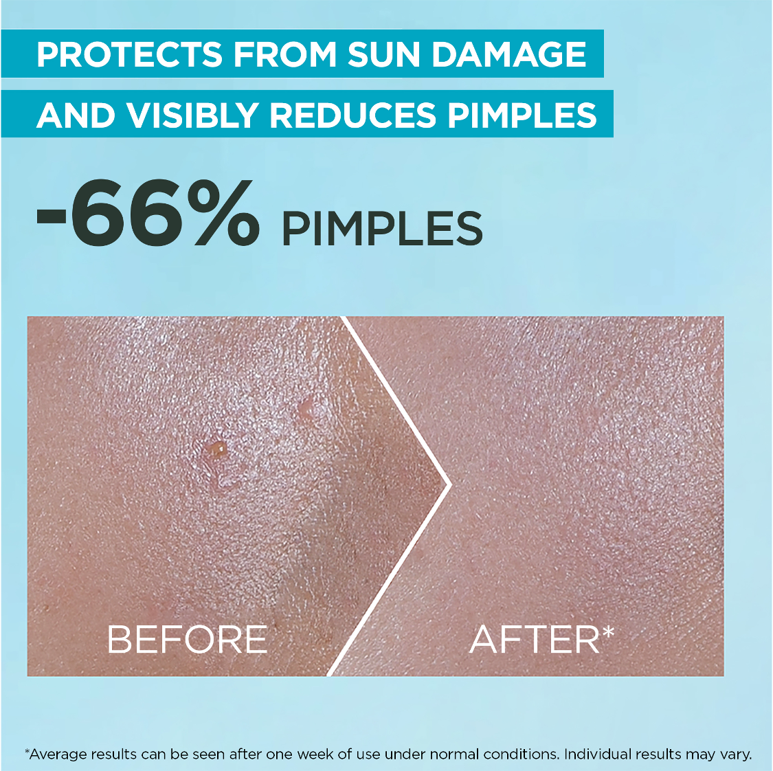 Super UV Anti-Acne SPF50+ Sunscreen– 12H Oil Control