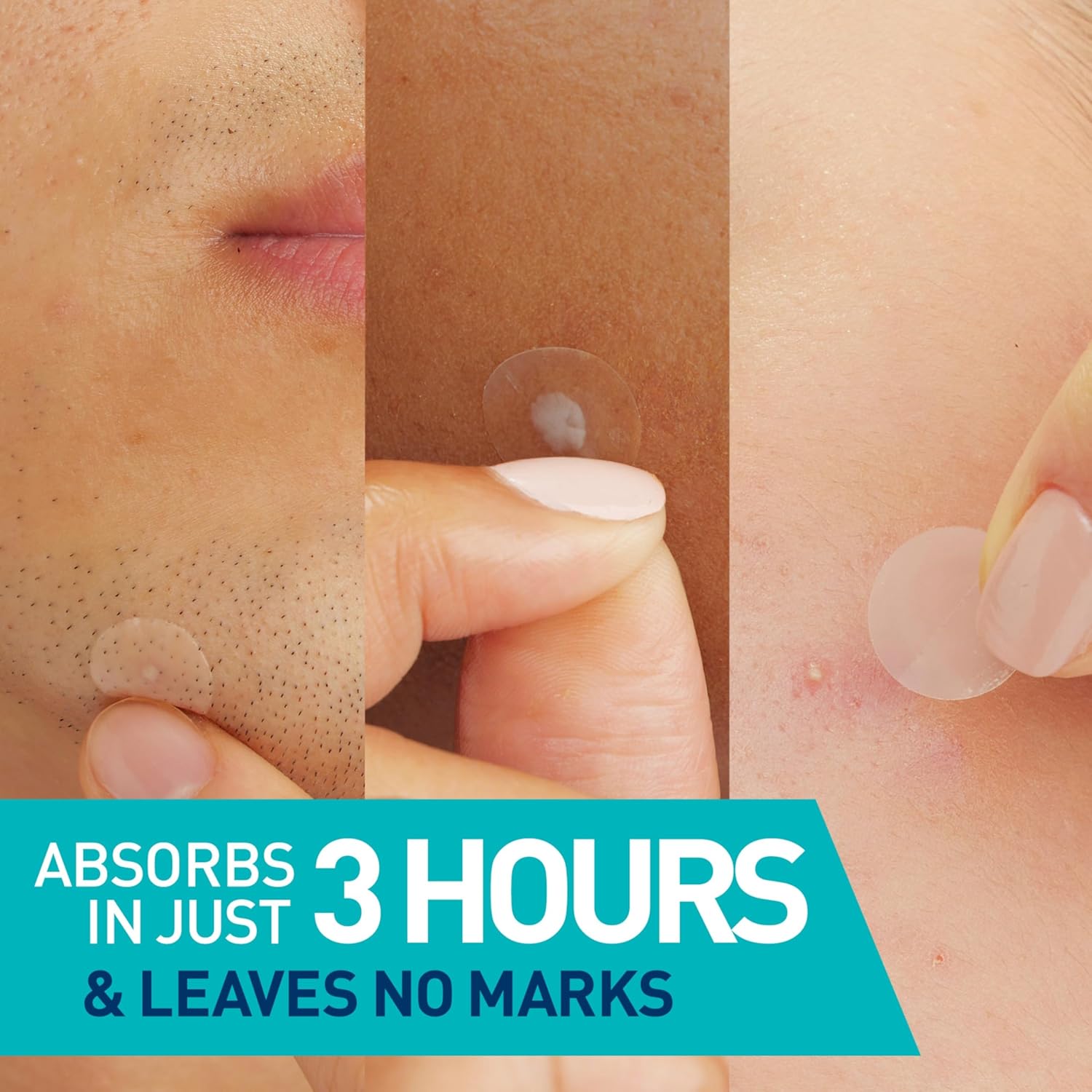 Blemish Barrier Patches With 3 Essential Ceramides and Niacinamide, 22pcs