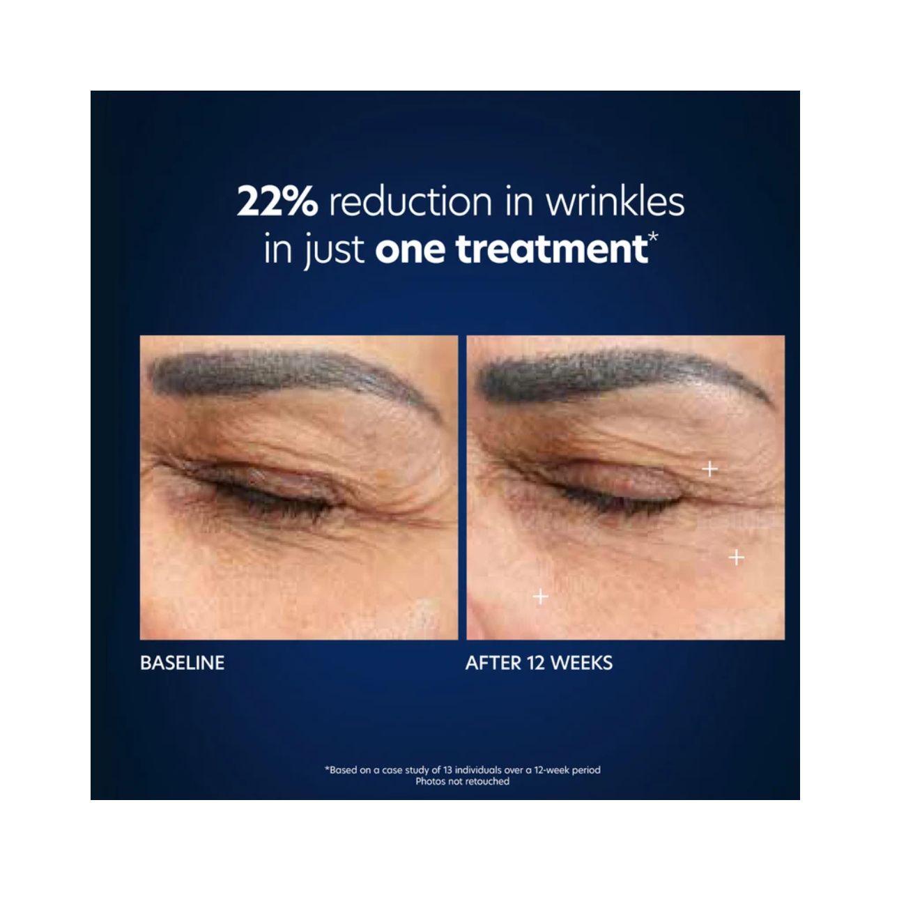 PCA Skin Hyaluronic Acid Microneedle Eye Patches