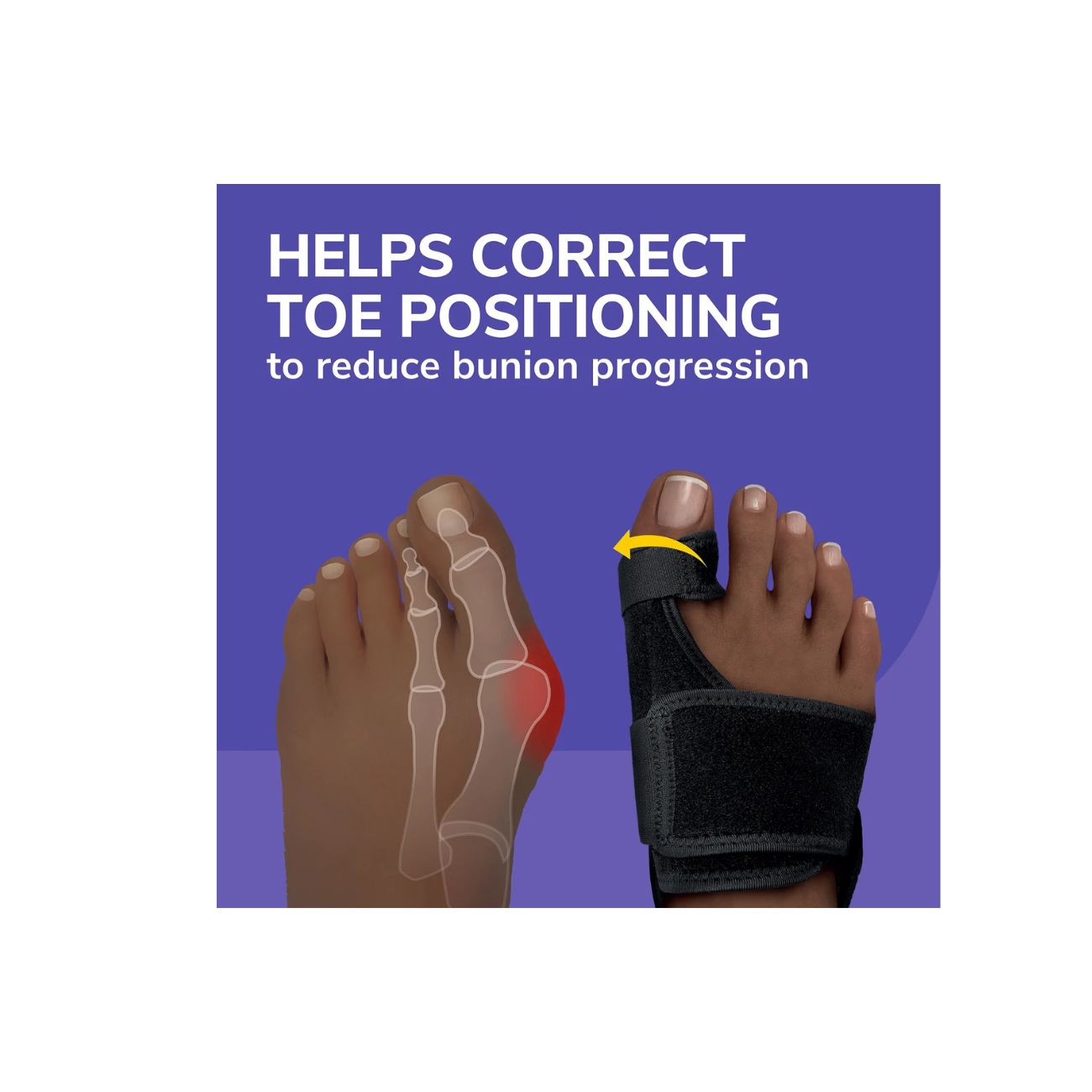 Bunion Relief & Toe Corrector