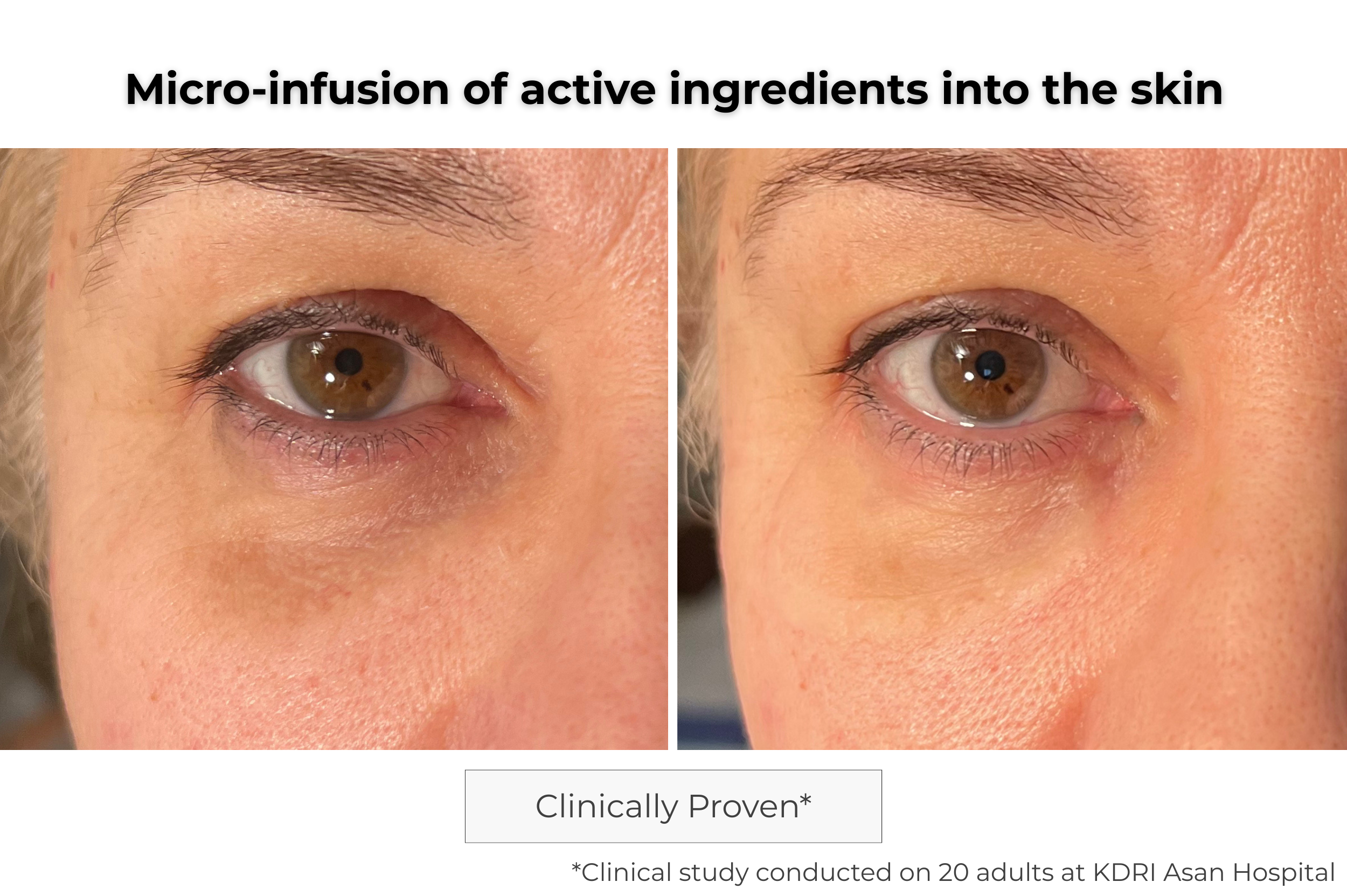 Microneedling Eye Patch