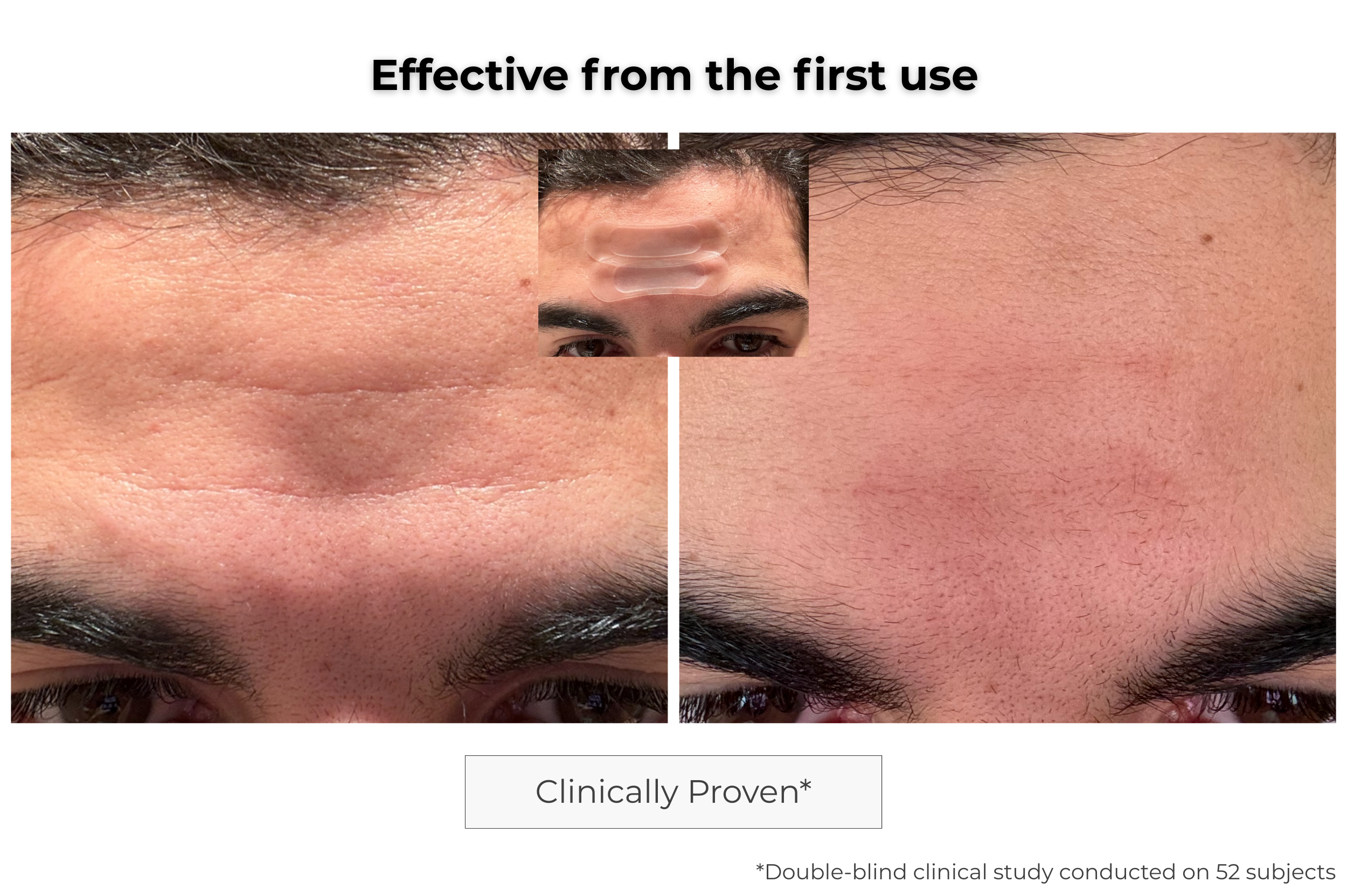 Microneedling Anti-Aging Patch