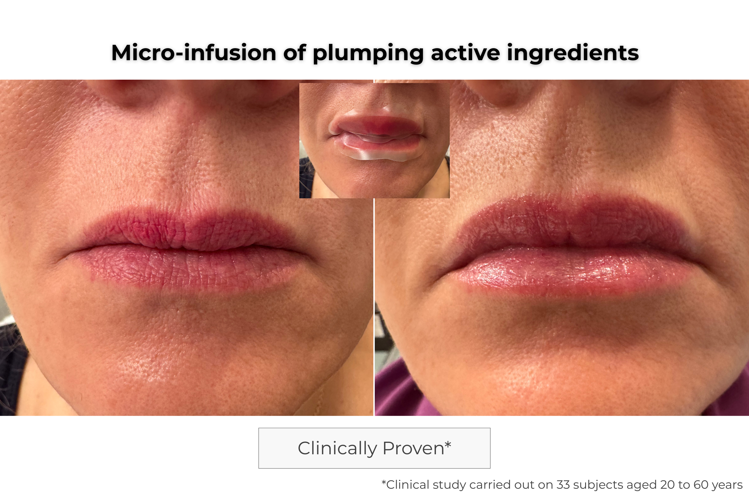 Microneedling Lip Patch