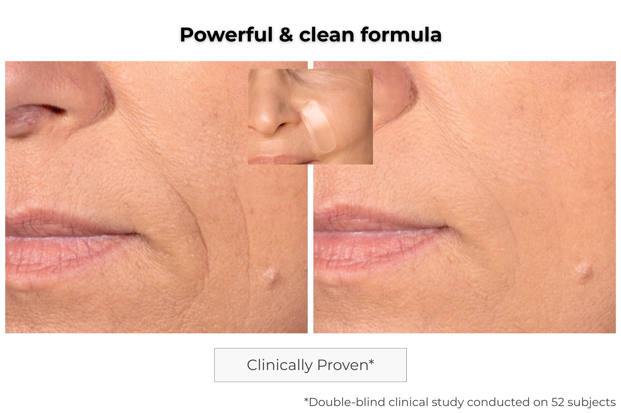 Microneedling Anti-Aging Patch