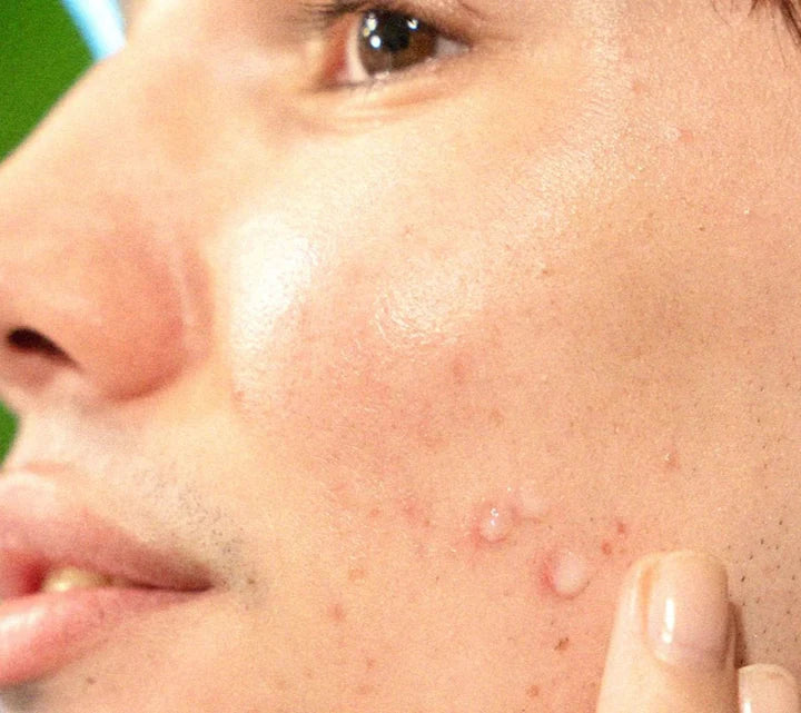 Face It® Pimple Patches