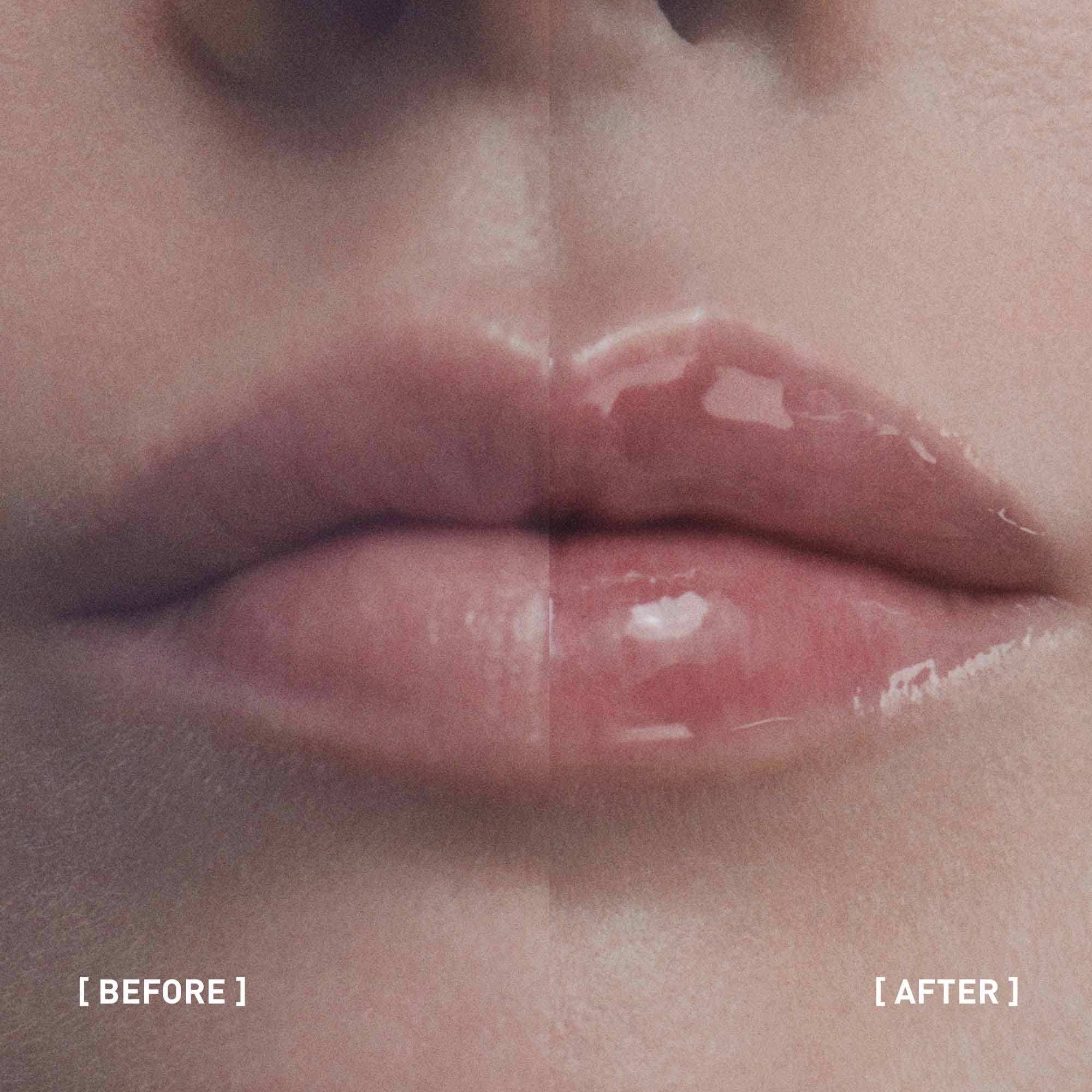 Hyalu Filler Lips
