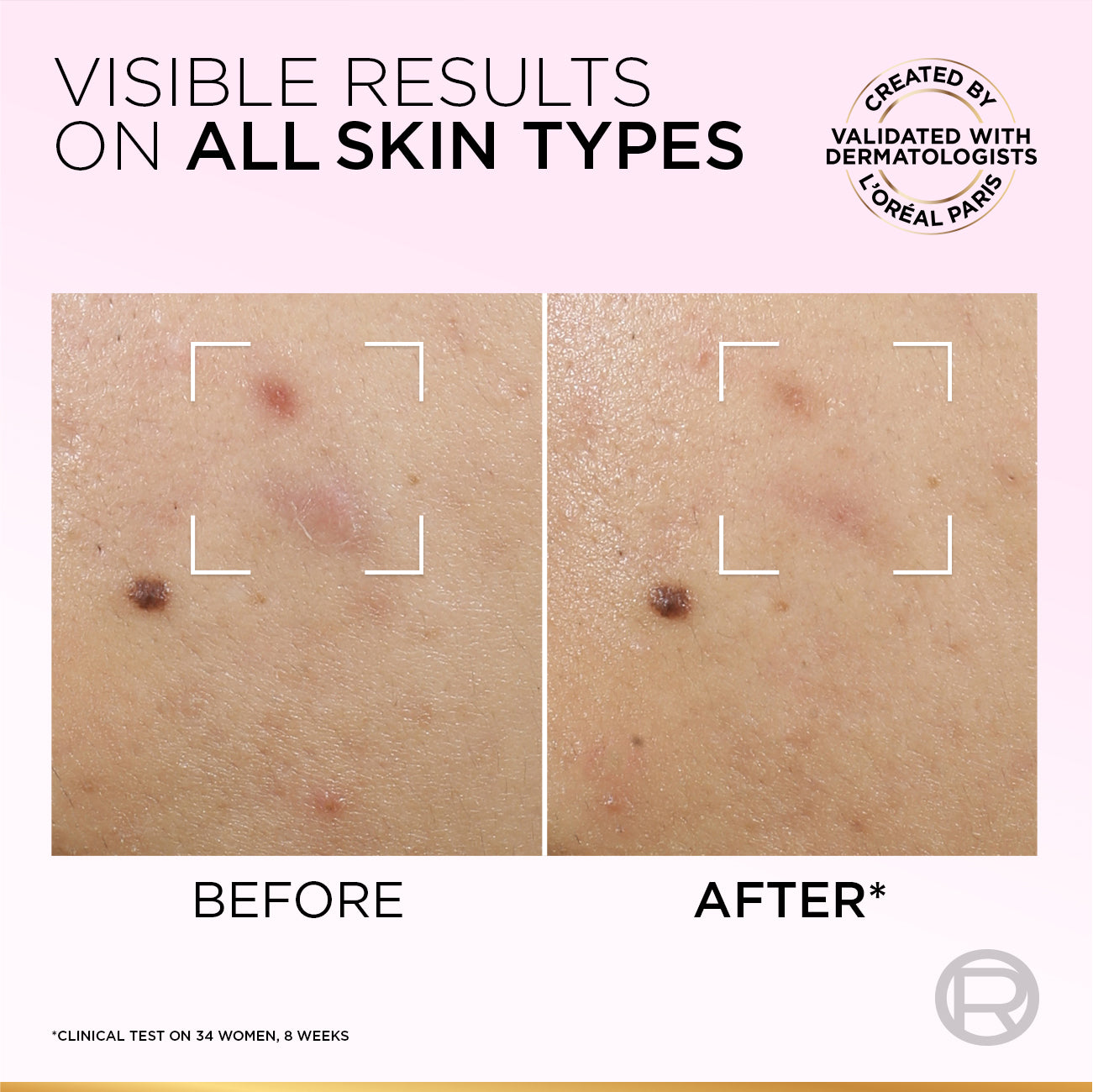 L’Oréal Paris Glycolic-Bright Anti-Dark Spot Exfoliant Peel 15% AHA + BHA + PHA + Niacinamide 25ml.