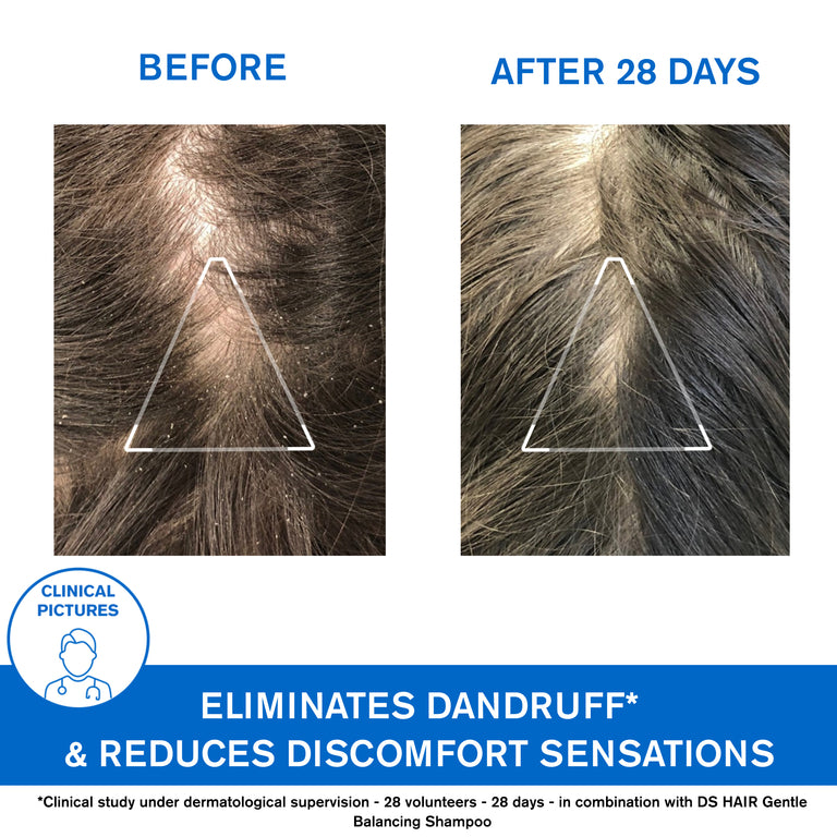 DS Hair Anti-Dandruff Treatment Shampoo - Moderate Dandruff & Irritated Scalp
