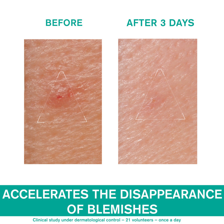 Hyséac SOS Paste - Local Skin-Care - Oily Skin with Blemishes