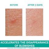 Hyséac SOS Paste - Local Skin-Care - Oily Skin with Blemishes