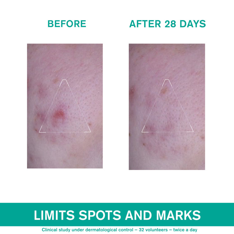 Hyséac 3-Regul Global Skin-Care - Oily Skin with Blemishes