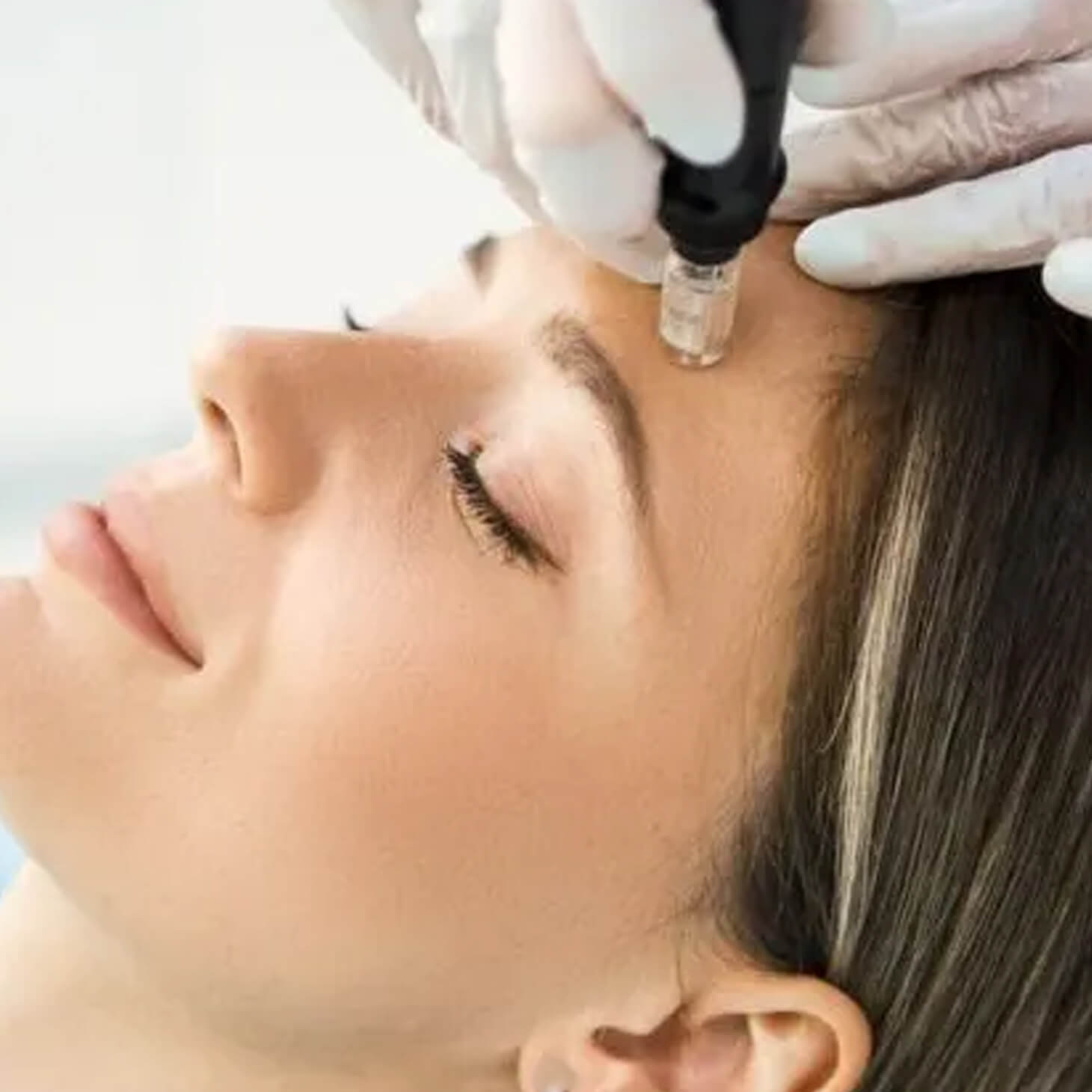 Microneedling Treatment