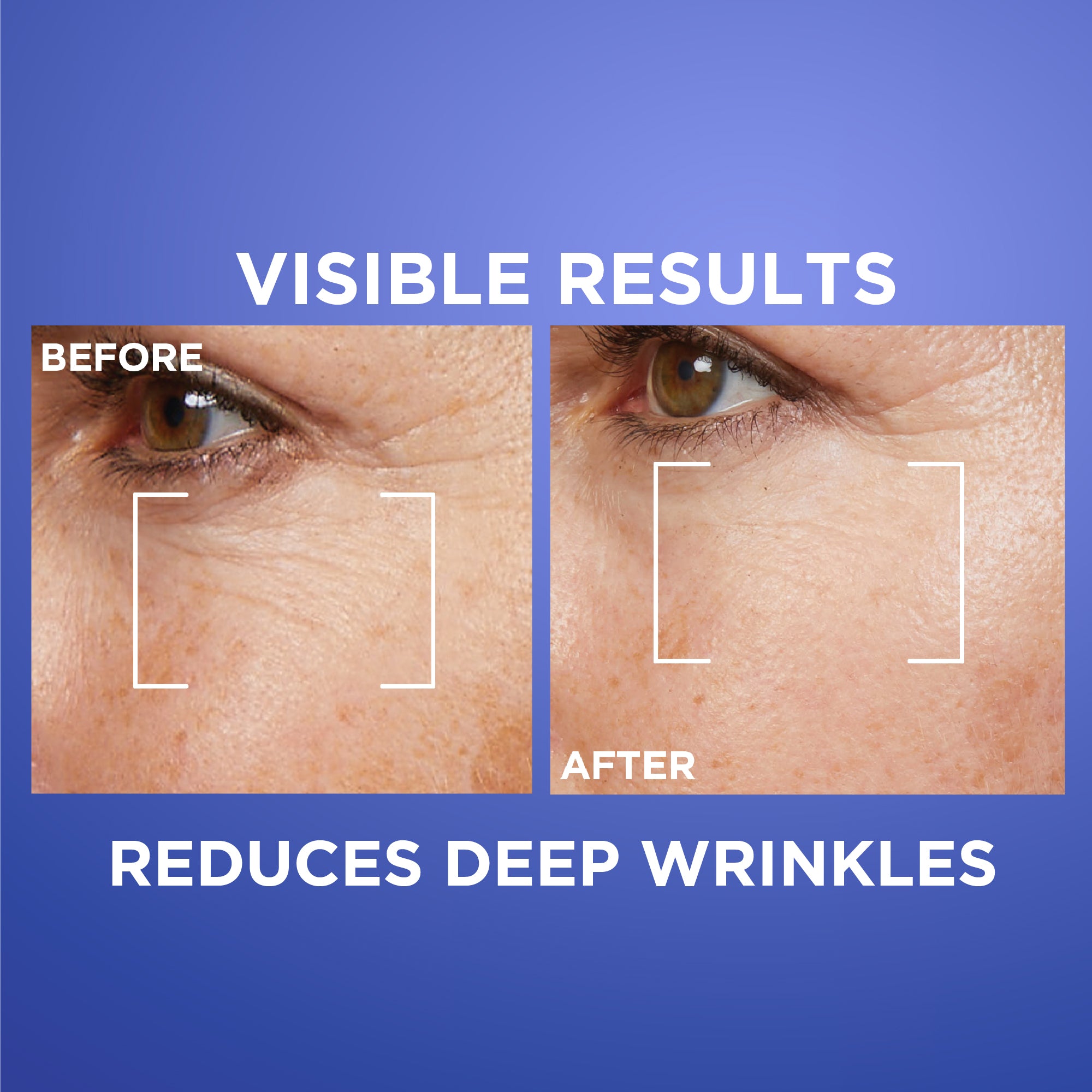 L'Oreal Paris Revitalift Retinol Night Serum For Face, With 0.2% Pure Retinol, Moisturizes Skin and Eliminates Deep Wrinkles, For All Skin Types